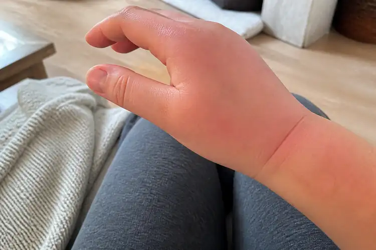 Oedeem en pijn na gips